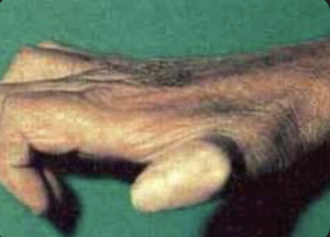 <p>weakness resulting in extension of the MCP joint and flexion of. the PIP and DIP joint </p>