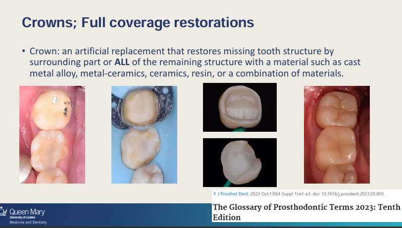 <ul><li><p>An artificial replacement that restores missing tooth structure by surrounding part or all of the remaining structure with a material such as cast metal alloy, metal-ceramics, ceramics, resin, or a combination of materials </p></li></ul><p></p>
