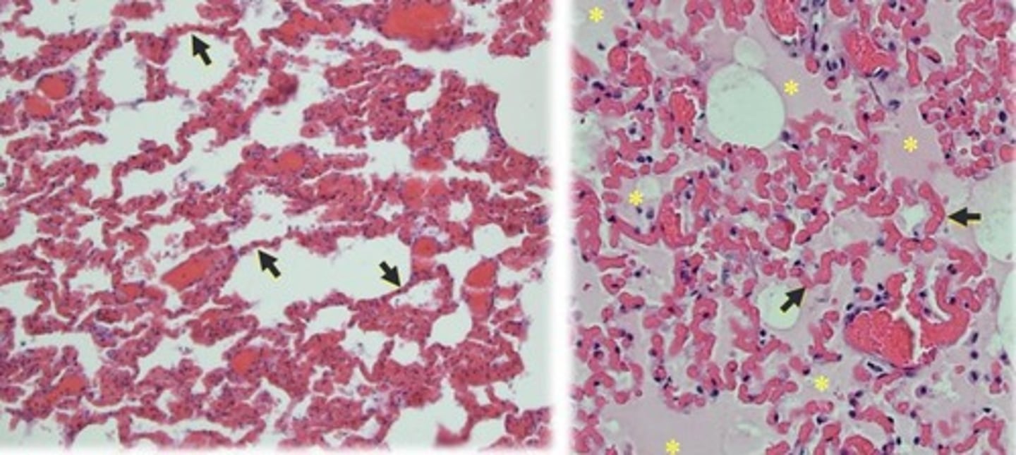<p>Alveolar septae (arrows) are filled with blood. The alveolar spaces are filled with eosinophilic oedema fluid</p>