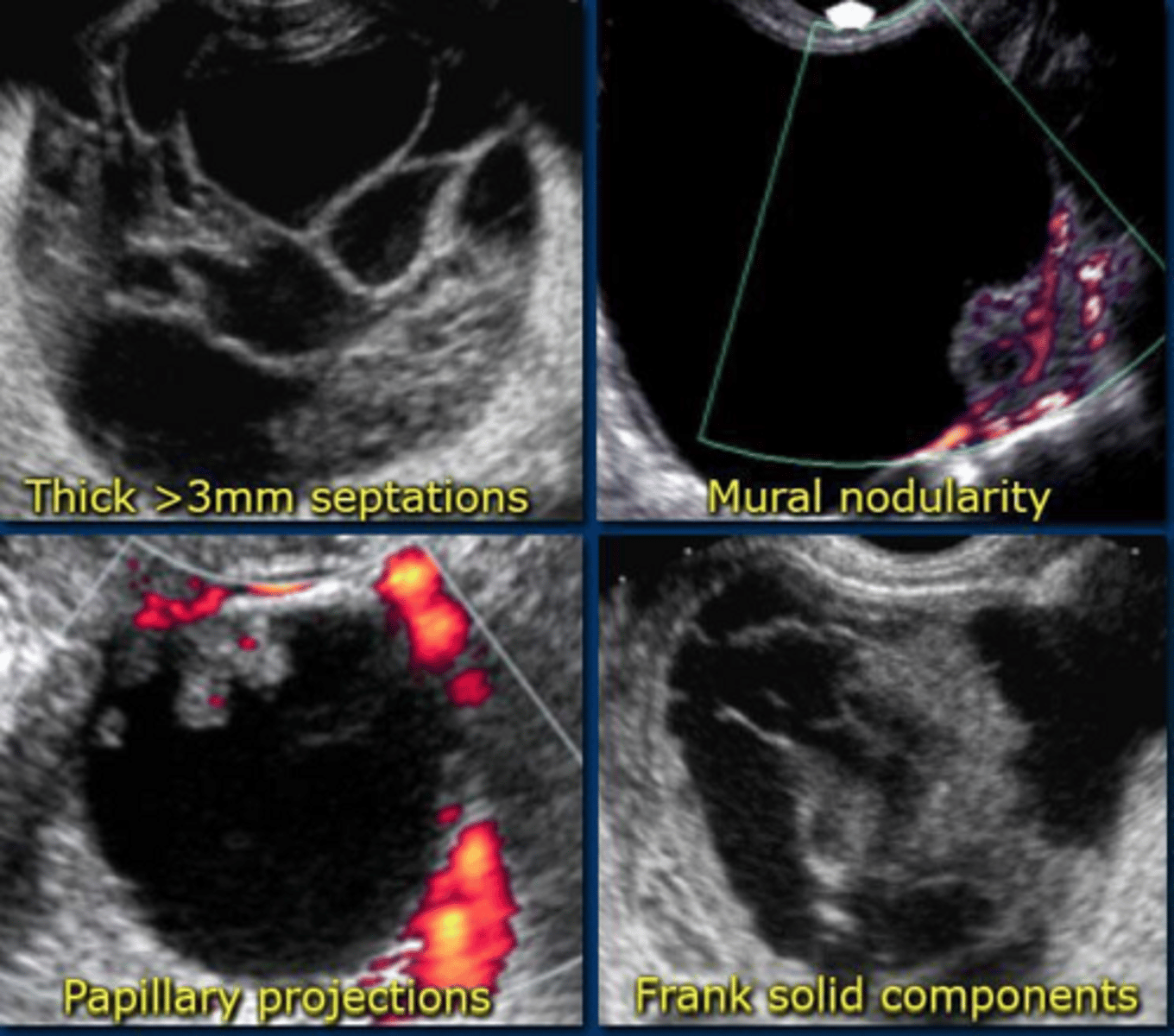 <p>Solid components, thick septations, irregular borders, and internal vascularity on Doppler.</p>