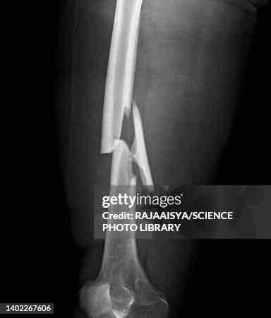 <p>Bone shatters into multiple pieces</p>
