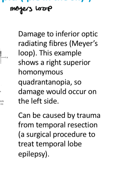 <p>Homonymous superior quadrontopia</p>