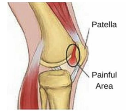 <ul><li><p><strong>Diffuse peripatellar or retropatellar pain with insidious onset</strong></p></li><li><p>spread-out pain around and behind patella. not sharp</p></li></ul><ul><li><p>worse with</p><ul><li><p>squatting</p></li><li><p>stair climbing</p></li><li><p>prolonged sitting with knees flexed (movie goers sign)</p></li></ul></li></ul><p></p>