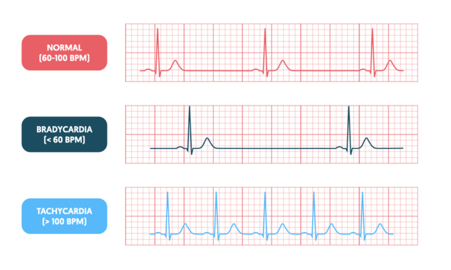 <ol><li><p>What is the exact rate </p></li><li><p>Is the atrial rate the same as ventricular rate?</p></li></ol><p></p>