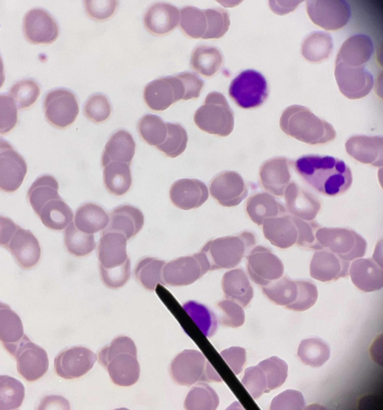 <p>A. Identify the pointed cell</p><p>B. Describe the striking feature</p><p>C. Associated with what conditions?</p><p>D. Primary stimulus of this formation?</p><p>E. What laboratory test increases in this formation?</p><p>F. What happens to the zeta potential?</p>