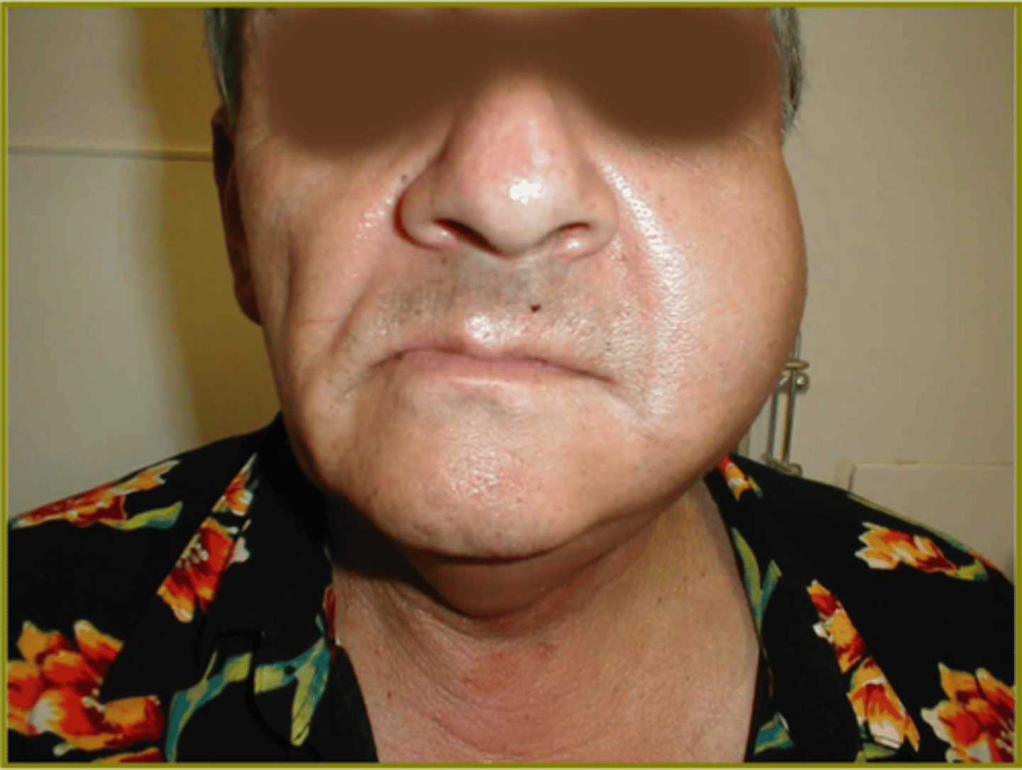 <p>Swelling and Pain of Gland (parotid and submandibular)</p><p>Pus can be expelled from duct</p>