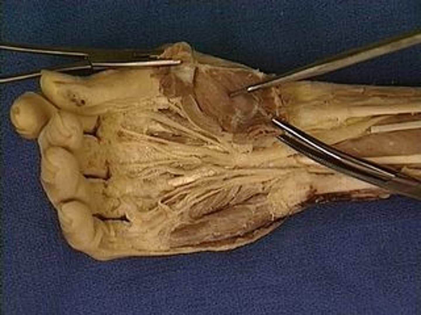 <p>carpal bones and flexor retinaculum</p>