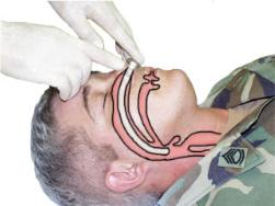 <ul><li><p>Airway adjunct inserted through the nose into the posterior pharynx</p></li><li><p>Maintains upper airway patency by bypassing obstruction from the tongue or secretions</p></li></ul><p></p>
