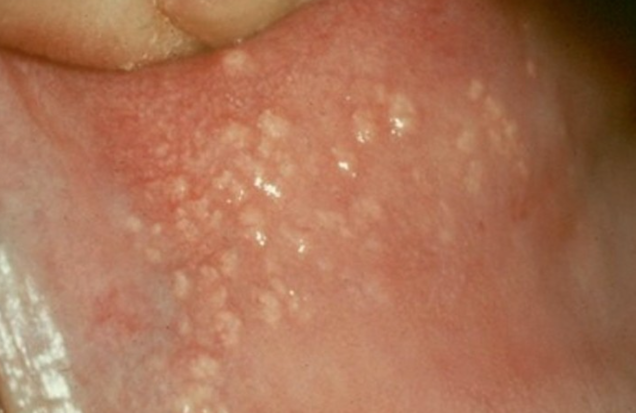 <p>4b. What is the etiology of this lesion?</p>