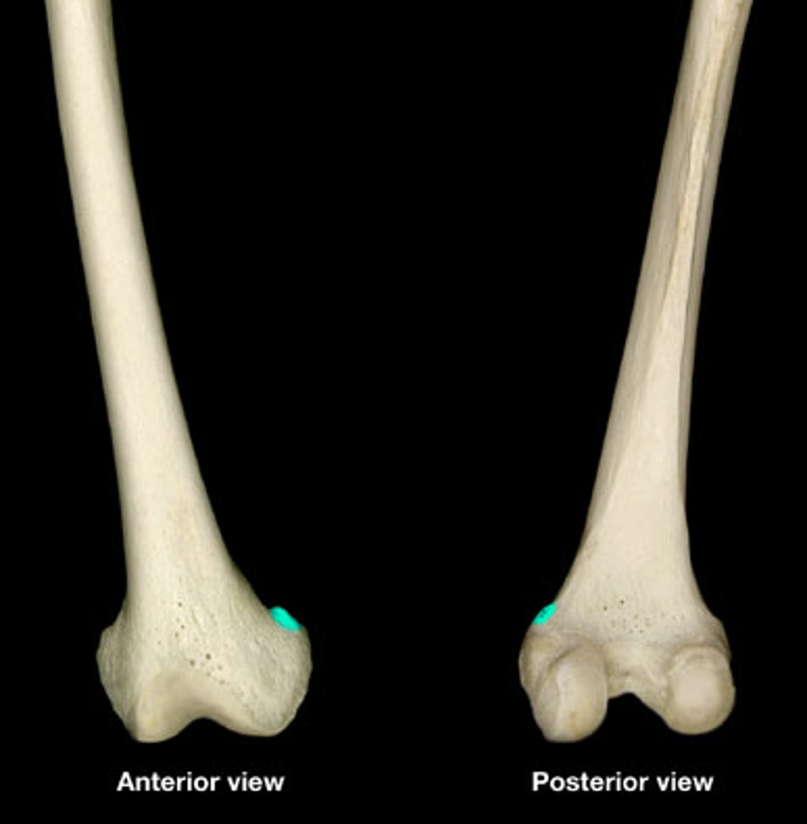 <p>- superior to medial epicondyle</p><p>- insertion for many adductor muscles (groin)</p>