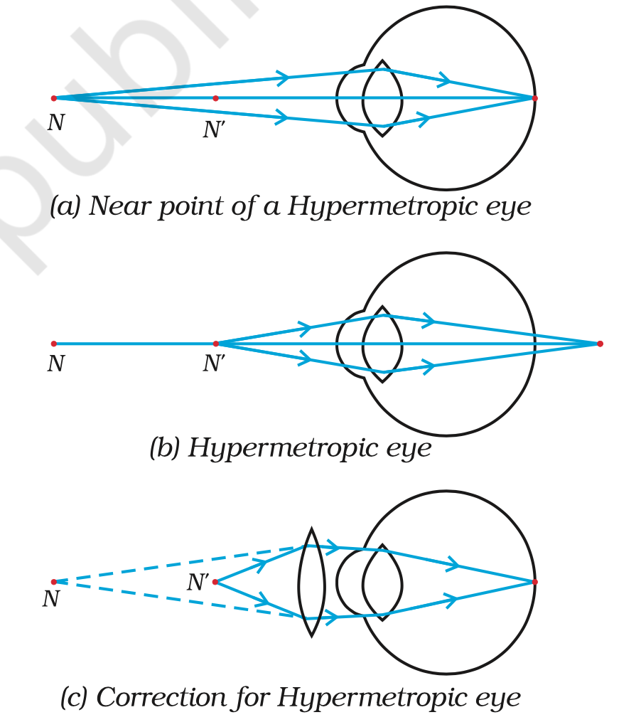 <p>Hypermetropia</p><ol><li><p>Also known as far or long sightedness. It is when one can view far away objects clearly but not the nearby ones.</p></li><li><p>Mostly occurs due to old age , with decrease in curvature and power of the lens and shortening of eyeballs.</p></li><li><p>In this case the image is formed behind the retina.</p></li><li><p>It can be corrected by the use of a convex lens as it acts in the opposite power.</p></li></ol><p></p><p></p>