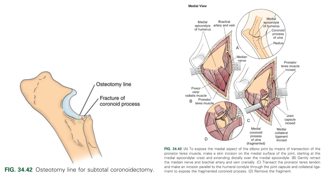 <ol><li><p>Arthroscopy: subtotal osteotomy of medial condyle (MCP microfracturing (to allow blood flow to the area) → fibrocartilage fills the area over time. Need tenotomy of biceps tendon and pronator teres muscle via incision of medial collateral ligament to improve view).  </p></li><li><p>Arthrotomy: total osteotomy of medial condyle of humerus → remove coronoid fragment from the ulna → lag screw insertion</p></li></ol><p></p>