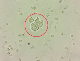 <ul><li><p>few present in normal</p></li><li><p>increased amounts associated with tubular necrosis, renal damage</p></li><li><p>most significant epithelial cell</p></li></ul><p></p>