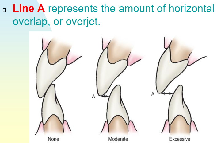 <p>The amount of facial horizontal overlap of the maxillary teeth. </p>