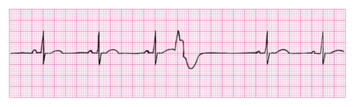 <p>Ventricular bc QRS is affected</p>