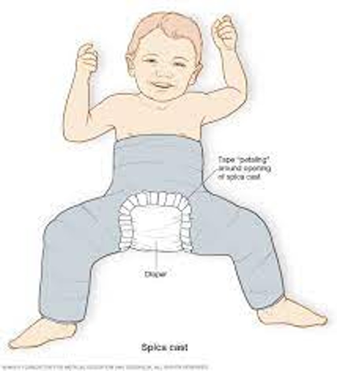 <p>Surgical closed reduction with placement of hip spica cast.</p><p>-Needs adjusted to accommodate growth</p><p>-Prepare for surgery</p><p>-Neuro checks</p><p>-Assess post op pain</p><p>-Skin/cast care</p>