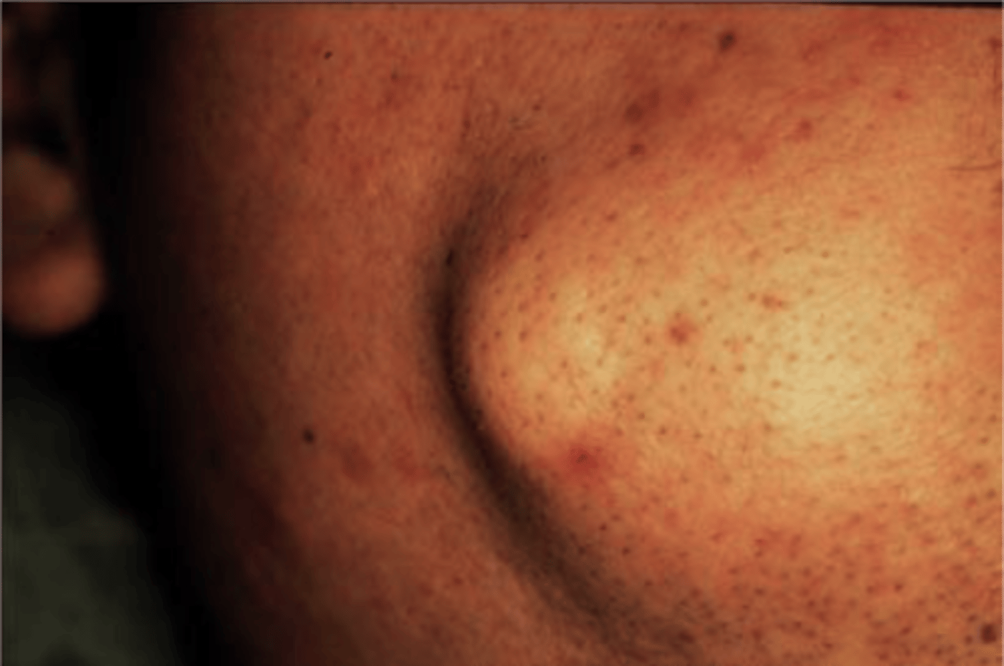 <p>epidermoid cyst</p>