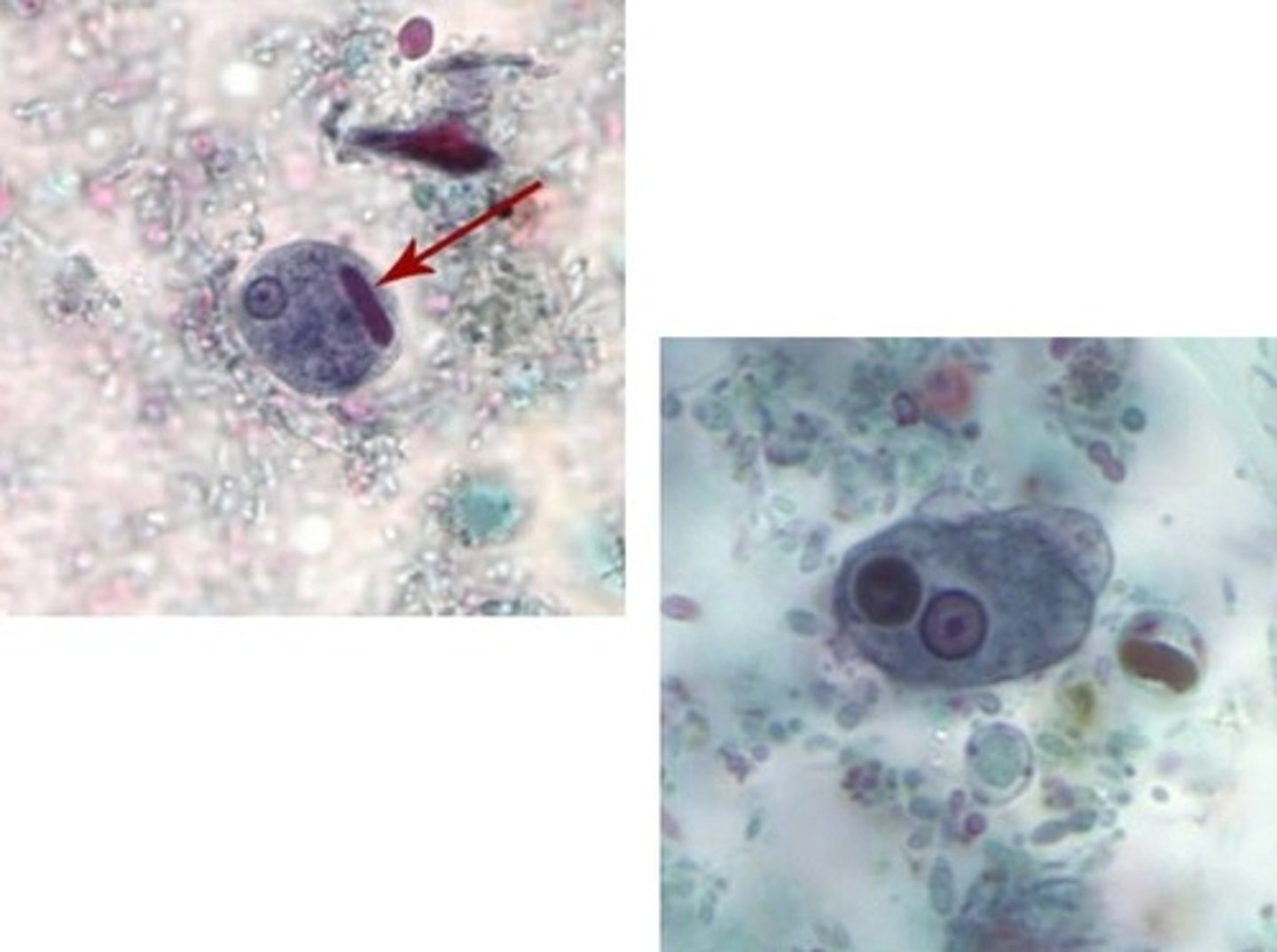 <p>• Cyst (left)</p><p>o Up to 4 nuclei</p><p>o Chromatoidal body with</p><p>smooth ends</p><p>• Trophozoite (right)</p><p>o 15-20 microns</p><p>o Small, central karyosome</p><p>and fine peripheral</p><p>chromatin</p><p>o May see</p><p>erythrophagocytosis</p><p>(diagnostic)</p>