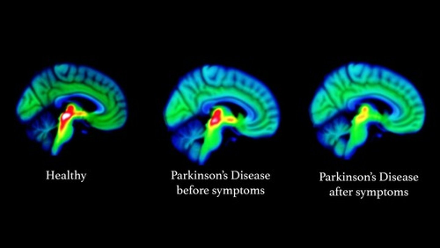 <p>Results from degeneration of dopamine-releasing neurons, which causes the deprive basal nuclei they target to become overactive and produce the well-known symptoms of tremors at rest,</p><p>Cause still unknown, but may be environmental</p>