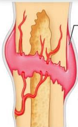 first stage of healing of a bone fracture. since blood vessels were ruptured when bone broke, blood-filled swelling or a bruise forms. bone cells are deprived of nutrition and die.