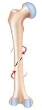 <p>happen when one of your bones is broken w/ a twisting motion<br>-create a fracture that wraps around your bone like a corkscrew</p>