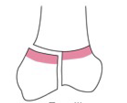 <p>Name this fracture</p>