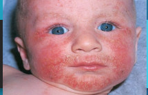 <p><strong>Eczema/Atopic Dermatitis: Symptoms</strong></p><p>-Symptoms</p><ul><li><p>____________ papules/plaques with ____-defined borders and overlying _____ or hyperkeratosis </p></li><li><p>Pruritic </p></li><li><p>May weep</p></li><li><p>Skin fissures</p></li><li><p>Excoriations </p></li></ul><p>-Tend to have other _______ diseases like asthma and allergic rhinitis </p><p>-Location of Rash</p><ul><li><p>Infants → _____, scalp, extensor surfaces of ___________</p></li><li><p>Older children → __________ and popliteal fossae, head, ____</p></li></ul><p></p>