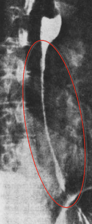 <p>What esophageal disorder is this?</p>