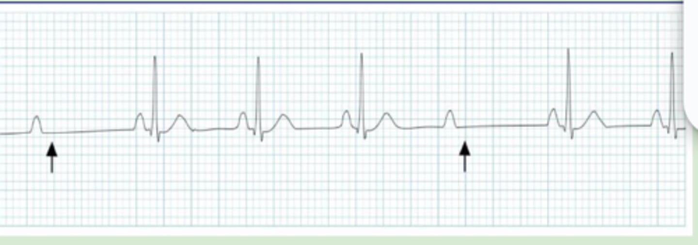 <p>Atrial impulses are locked sporadically</p><p>-NO prolongation prior to dropping of the QRS complex → PR interval will be constant</p>