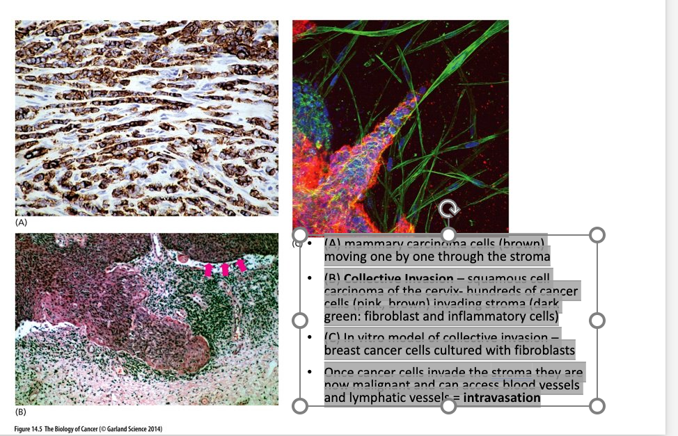 <ul><li><p class="Paragraph WhiteSpaceCollapse SCXP147905947 BCX0" style="text-align: left"><span>(A) mammary carcinoma cells (brown) moving one by one through the stroma​</span></p></li><li><p class="Paragraph WhiteSpaceCollapse SCXP147905947 BCX0" style="text-align: left"><span>(B) <strong>Collective Invasion </strong>– squamous cell carcinoma of the cervix- hundreds of cancer cells (pink, brown) invading stroma (dark green: fibroblast and inflammatory cells)​</span></p></li><li><p class="Paragraph WhiteSpaceCollapse SCXP147905947 BCX0" style="text-align: left"><span>(C) In vitro model of collective invasion – breast cancer cells cultured with fibroblasts​</span></p></li><li><p class="Paragraph WhiteSpaceCollapse SCXP147905947 BCX0" style="text-align: left"><span>Once cancer cells invade the stroma they are now malignant and can access blood vessels and lymphatic vessels = <strong>intravasation</strong>​</span></p></li></ul><p></p>