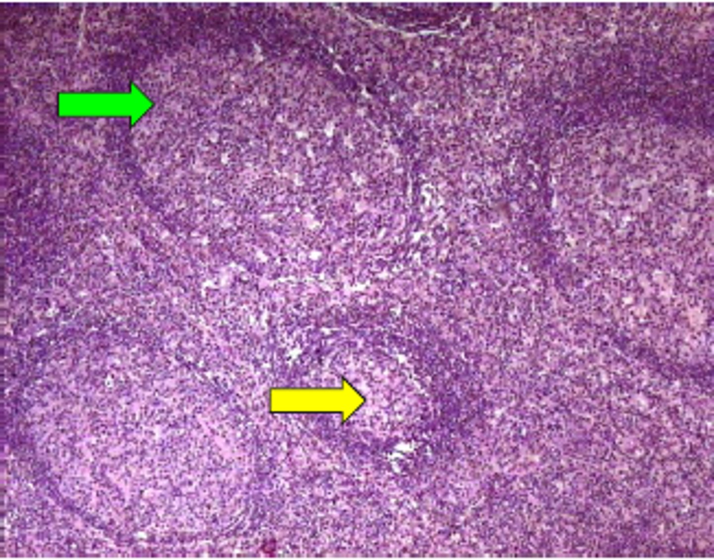 <p>enlarged secondary follicles bc of increased B cells (seen as regions)</p>
