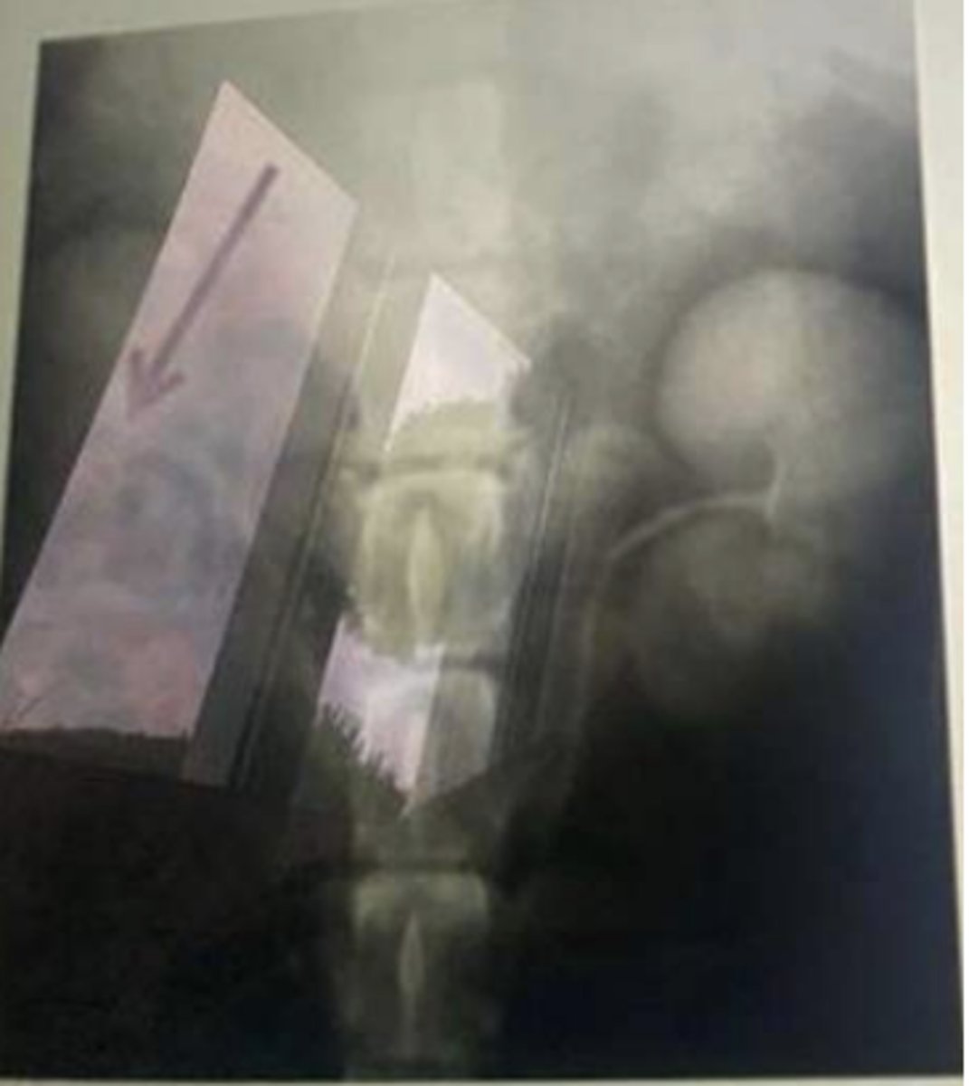 <p>In a ventrodorsal radiograph of the abdominal cavity in a dog, what is the structure the arrow is pointing at?</p><p>a) Renal vein</p><p>b) Ureter</p><p>c) Spleen</p><p>d) Pancreatic duct</p>