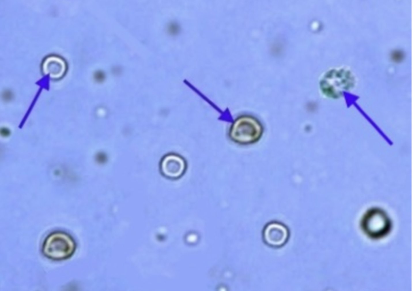 <p>smaller than WBCs but do not have a nucleus. They may be disc- or spherical-shaped or have spiked or crenated appearance. The top image illustrates the disc shape and crenated appearance. associated with damage to the glomerular membrane or vascular injury within the genitourinary tract.</p>