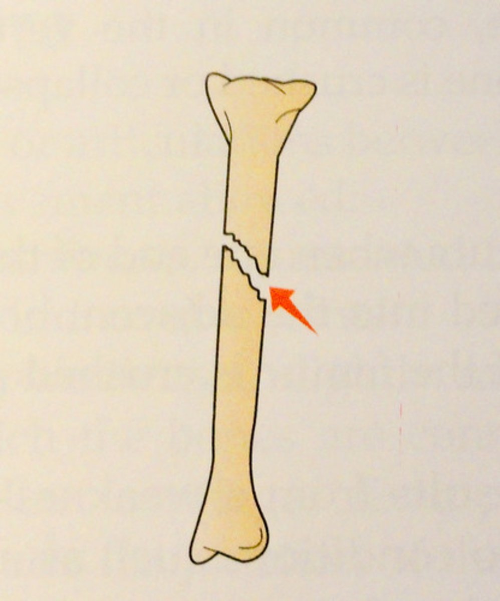<p>occurs at an angle across the bone</p>