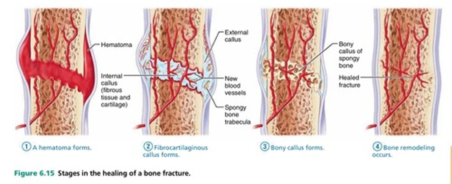 <p>Formation of hematoma.</p><p>Callus formation.</p><p>Conversion to hard callus.</p><p>Remodeling.</p>