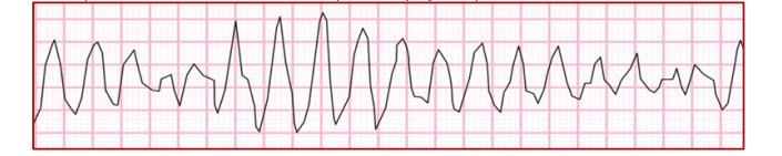 <p>Polymorphic V-Tach</p>