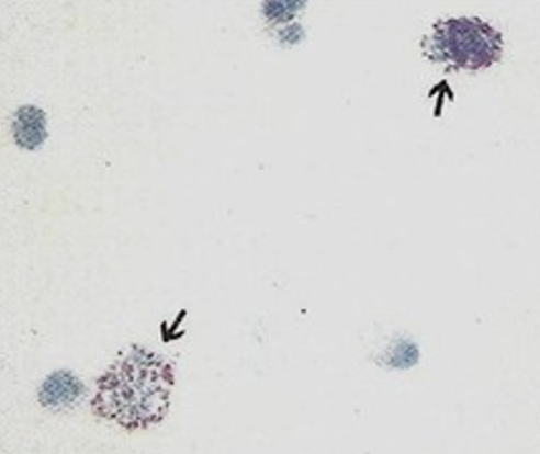 <p>What type of cell is shown from this urinalysis? What does it indicate?</p>