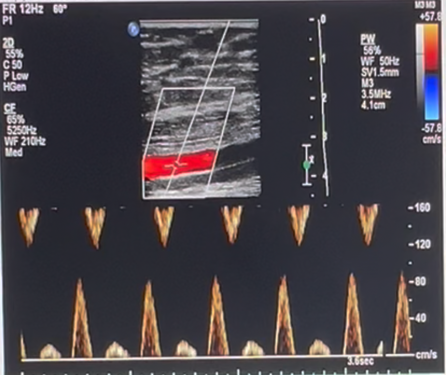 <p>What is the best way to adjust the console controls to eliminate the Doppler artifact?</p><p>a. increase the PW Doppler scale <br>b. turn down the Doppler gain<br>c. increase the sweep speed <br>d. raise the baseline</p>