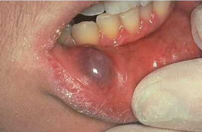 <p>In what demographic would you find a mucocele?</p>