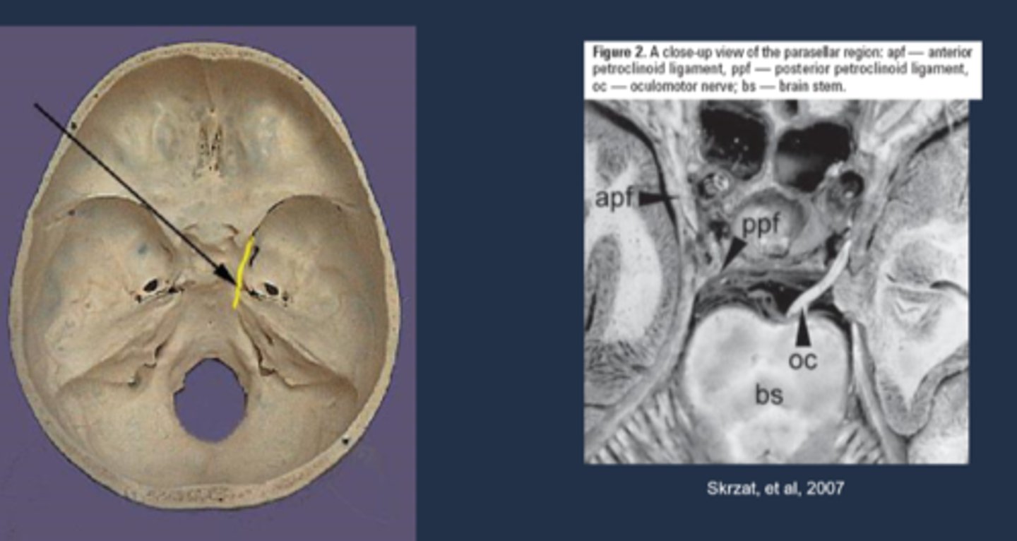 <p>CN III leaves brainstem = pupillomotor fibers move dorsomedially = uncus herniates = compresses CN III dorsomedially against petroclinoid ligament and dorsum sellae = pupil is blown</p>