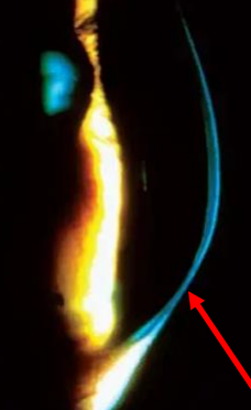 <ul><li><p>4-8’oclock location</p></li><li><p>1-2mm unaffected area between area of thinning and the limbus </p></li><li><p>may be a disease on the same spectrum as KCN</p></li><li><p>later age of onset</p></li><li><p>better vision for longer</p></li></ul>