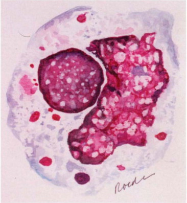 <p>monocytes or macrophages that have engulfed some nuclear material, not significant </p>