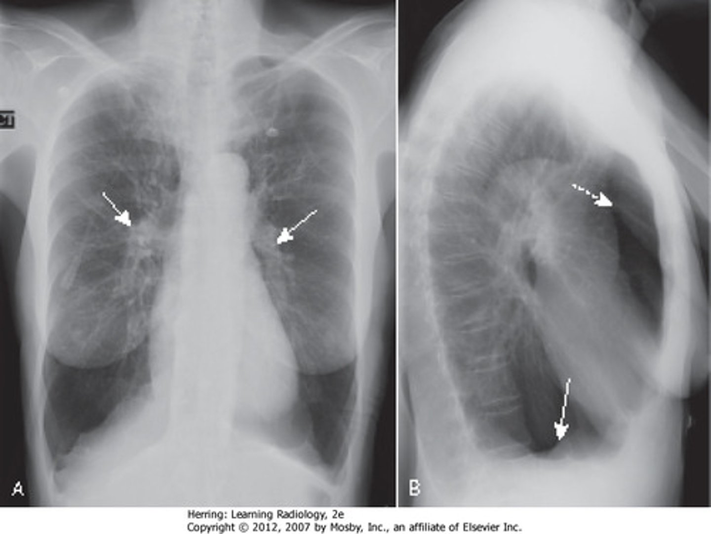 <p>Chronic Obstructive Pulmonary Disease (COPD)</p>