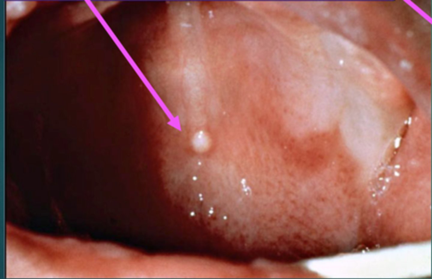 <p>Also called EPSTEIN'S PEARLS. Small, harmless, white or yellow NODULES that may appear along the newborn's GUMS or on the ROOF of their mouths. These are COMMON.</p>