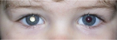 <p>What does this refer to</p><ul><li><p>Leukocoria</p></li><li><p>Strabismus</p></li><li><p>Red, painful eye with glaucoma</p></li><li><p>Nystagmus</p></li><li><p>Orbital cellulitis</p></li></ul><p></p>