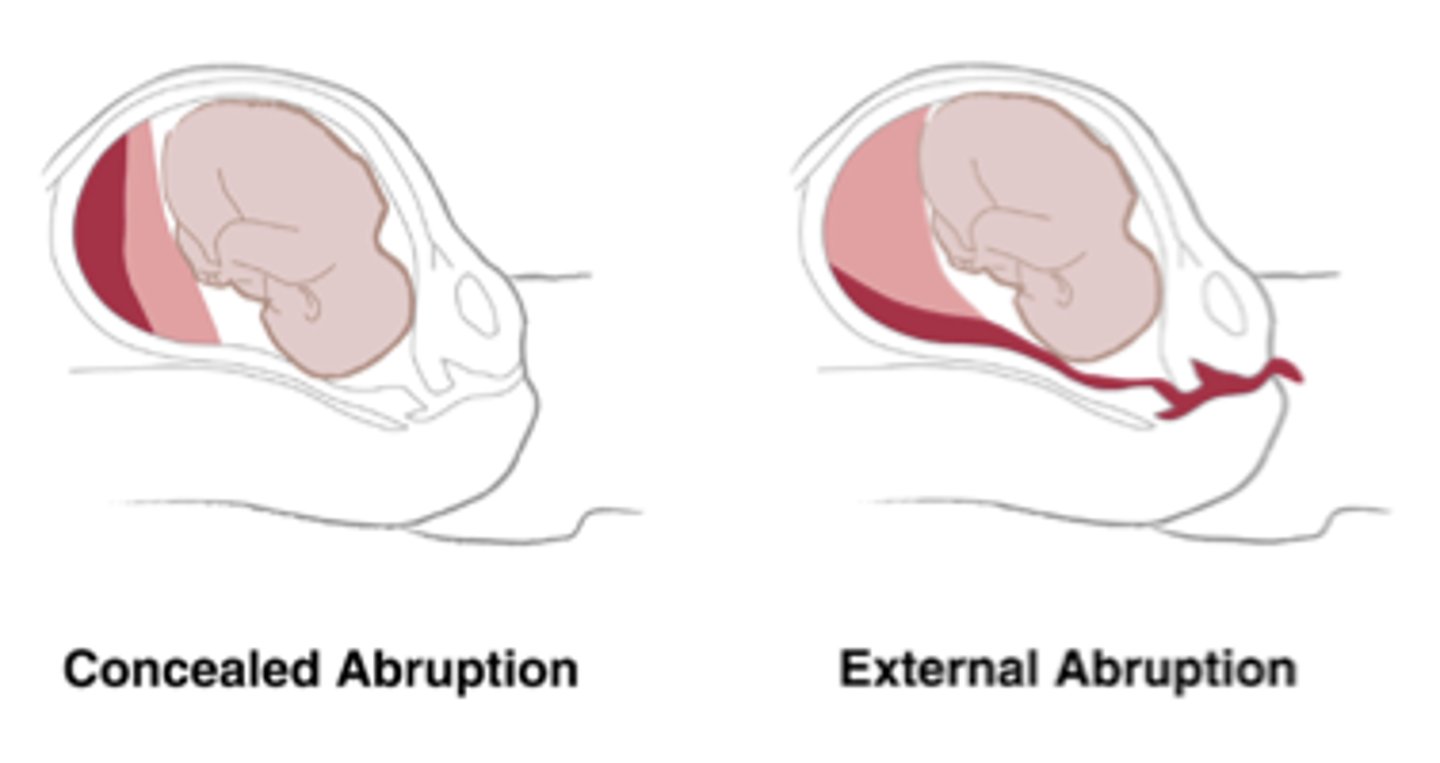 <p>Premature separation of placenta</p><p>Risk Factors</p><p>-Maternal hypertension</p><p>-Cocaine use (Causing hypertension)</p><p>-Abdominal trauma (Motor Vehicle Accident, Abuse)</p><p>-History of abruption (25% recurrence rate)</p><p>-Smoking</p><p>-Preterm Pre-labor Rupture Of Membranes</p>