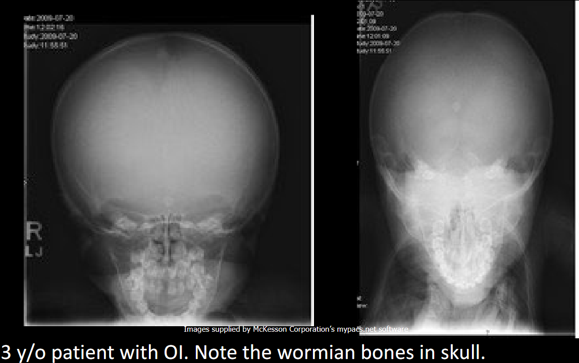 <p>Widened sutures and wormian bones.</p>