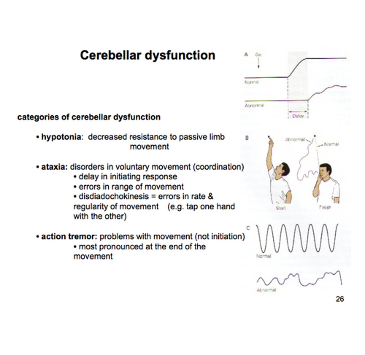 <p>Ipsilateral defects where the somatotopic organization is reflected</p><p>Lesions damaging the deep cerebellar nuclei produce more severe symptoms than lesions only damaging the cerebellar cortex</p><p>Signs and symptoms include hypotonia, disequilibrium, and dyssynergy</p>