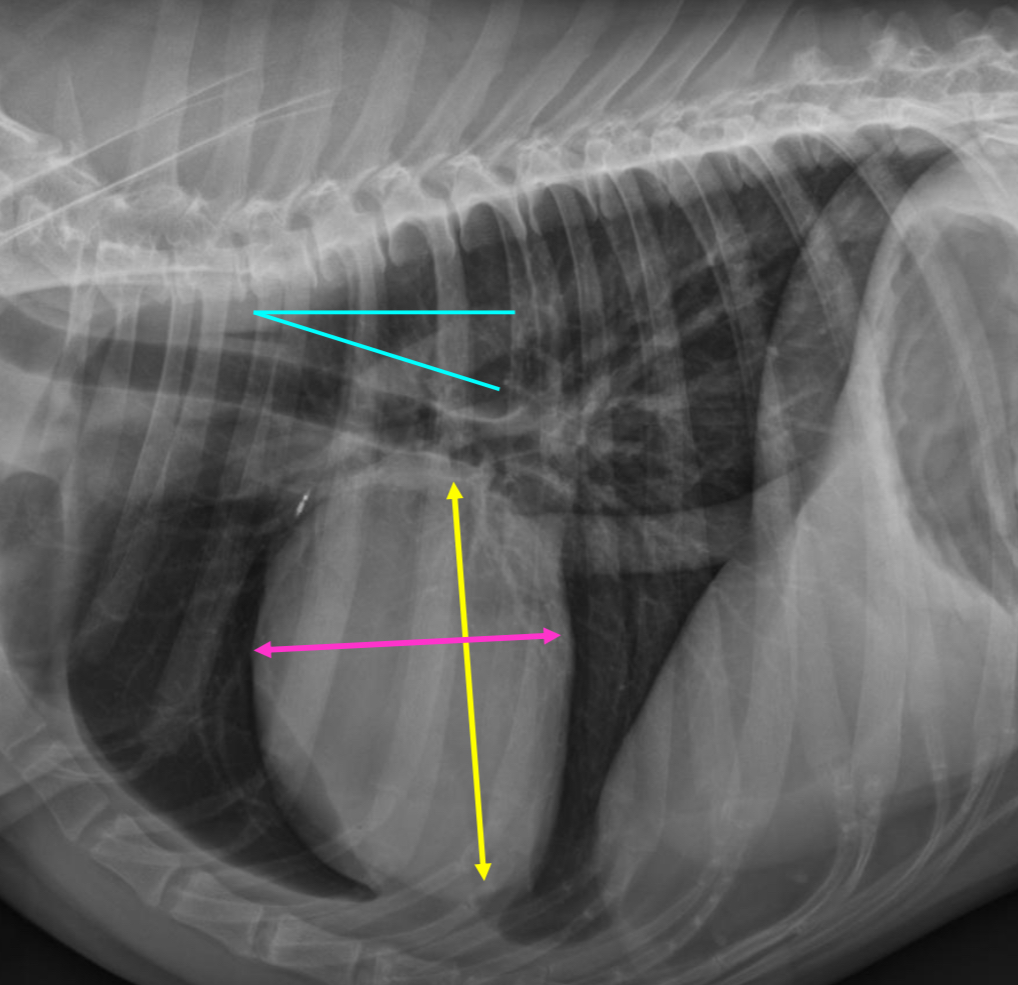 <p>-heart perpendicular to spine, 2/3 DV diameter</p><p>-2.5 IC spaces</p><p>-trachea deviates from spine</p>
