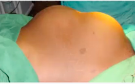 <p></p><ul><li><p>Sangrado onset: Precedido de contracciones + dolor abdominal súbito</p></li><li><p>Tono uterino: se pierde contracción</p></li><li><p>Monitoría fetal: sufrimiento fetal o fetocardia ausente</p></li><li><p>Tacto vaginal: no se palpa presentación</p></li><li><p>Hallazgos al ultrasonido: disruption of the myometrium, a hematoma adjacent to a previous hysterotomy scar, extrauterine fluid-distended fetal membranes, free peritoneal fluid, anhydramnios, an empty uterus with fetal parts outside of the uterus, and/or fetal demise.</p></li></ul><p></p><p>Signo de bandl</p><p></p>